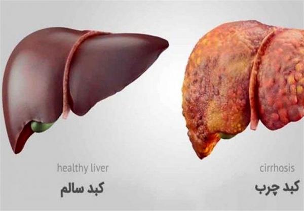 روزه برای درمان کبد چرب موثر است